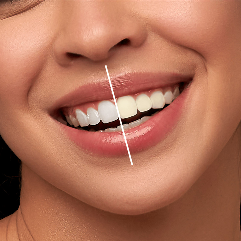 Blanchiment Dentaire